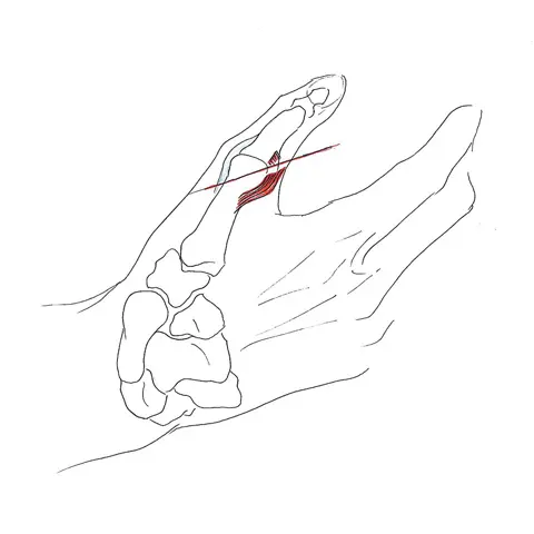 Thumb ulnar collateral ligament lesions