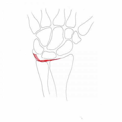 Triangular fibrocartilage complex lesions