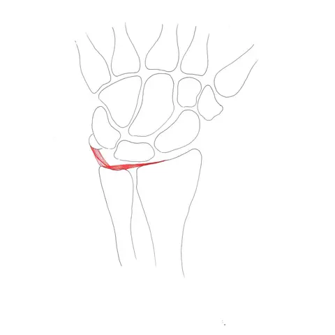 Triangular fibrocartilage complex lesions