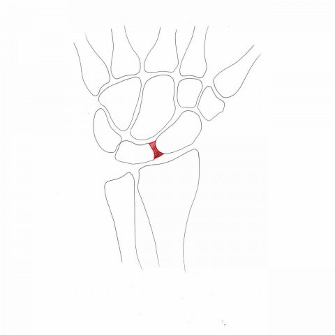 Scapho-lunate ligament lesions