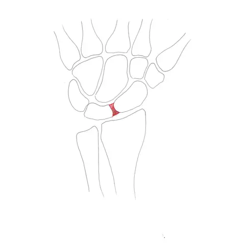 Scapho-lunate ligament lesions