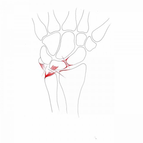 Lesioni legamentose del polso