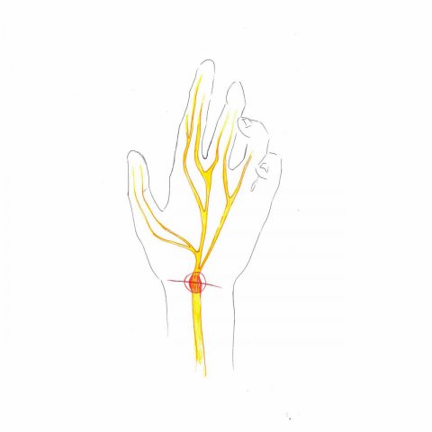 Peripheral nerve lesions