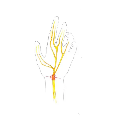 Peripheral nerve lesions