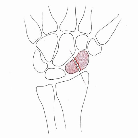 Scaphoid fracture