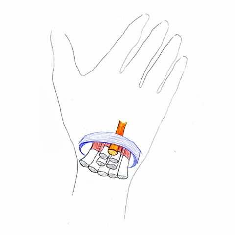 Carpal tunnel syndrome